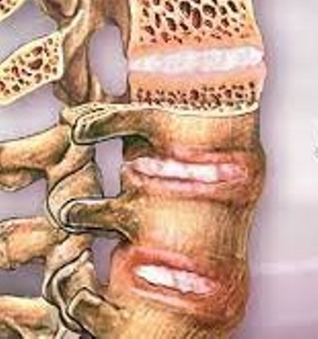 ankylosing-spondylitis-market