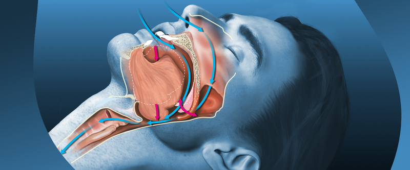 anti-snoring-treatment-market