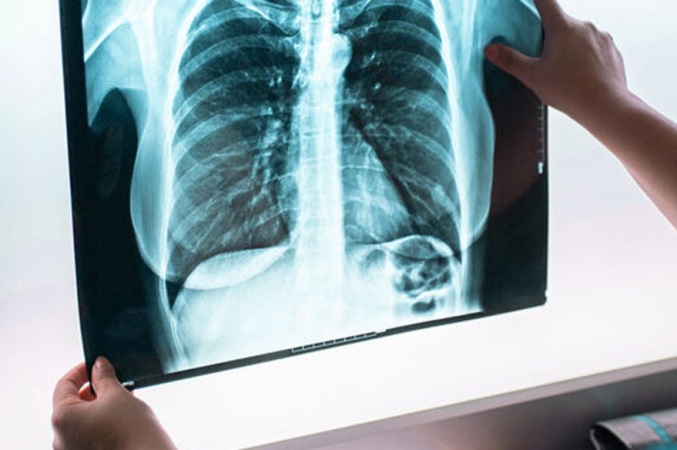 lung-cancer-diagnostics-market