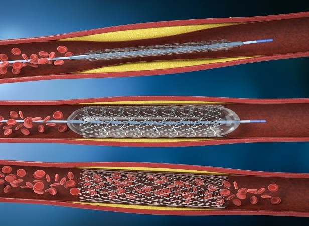 Peripheral vascular stents market