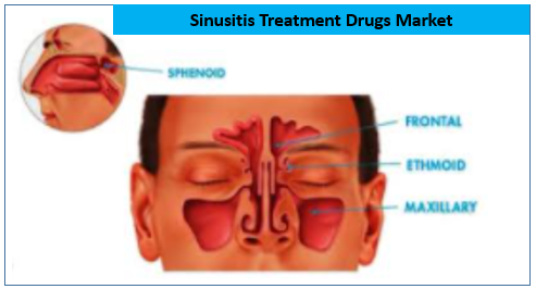 Sinusitis treatment drugs market 